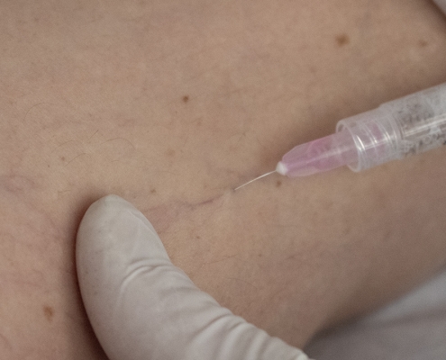 Escleroterapia