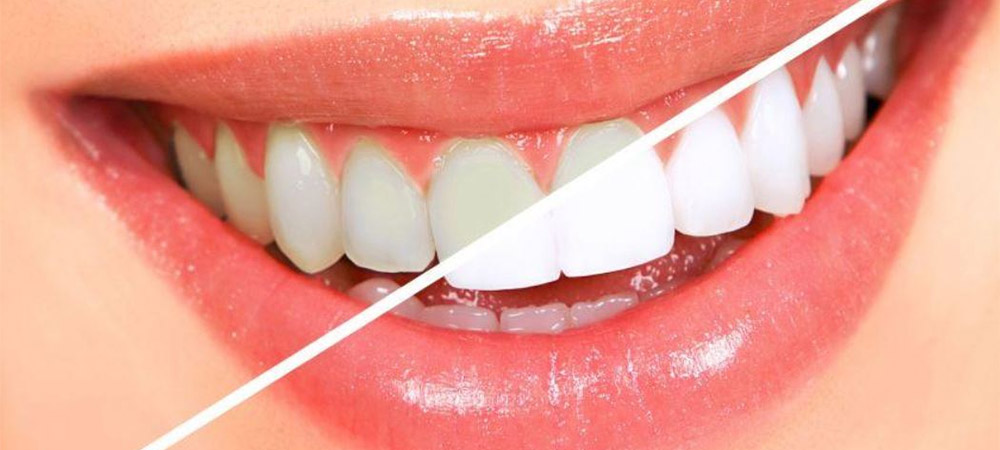 40% de descuento en blanqueamiento dental