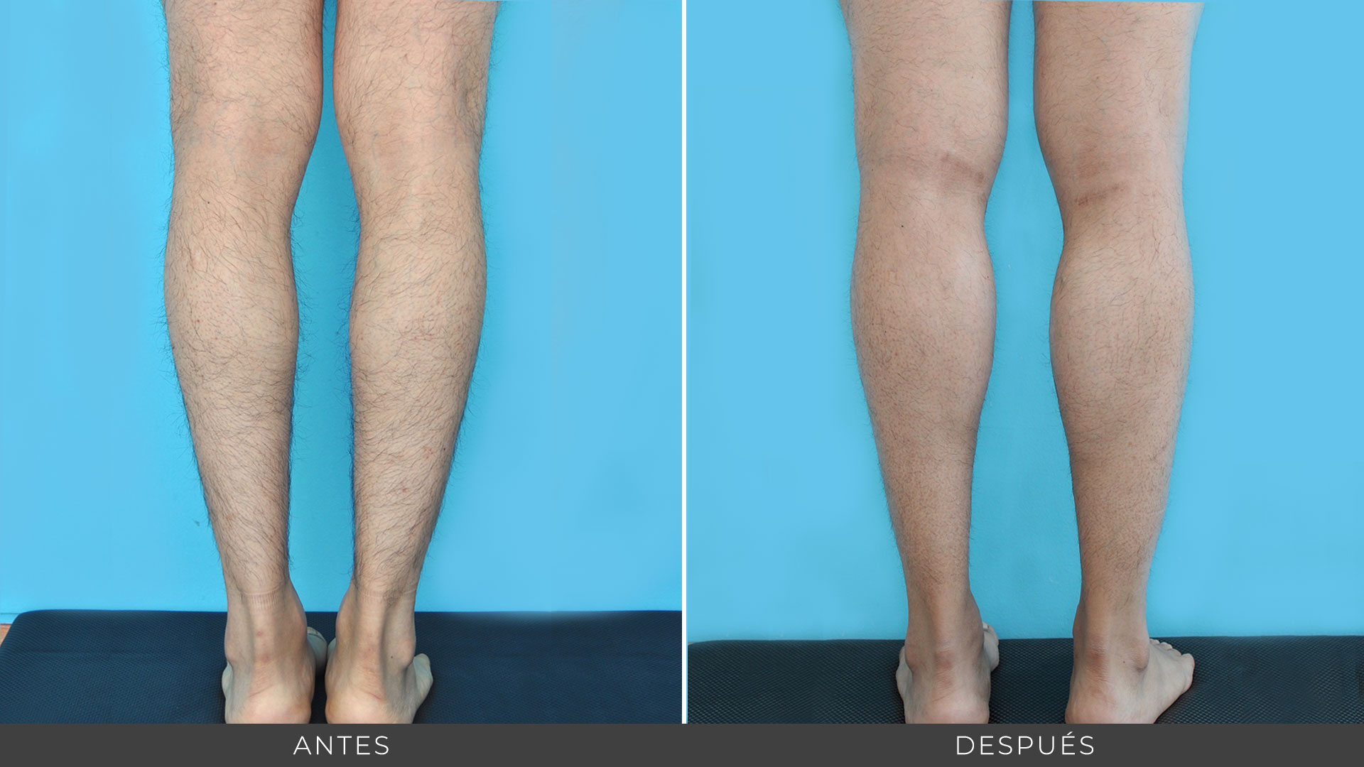 Aumento de pantorrillas con prótesis - Cirugía plástica Clínica La Parva