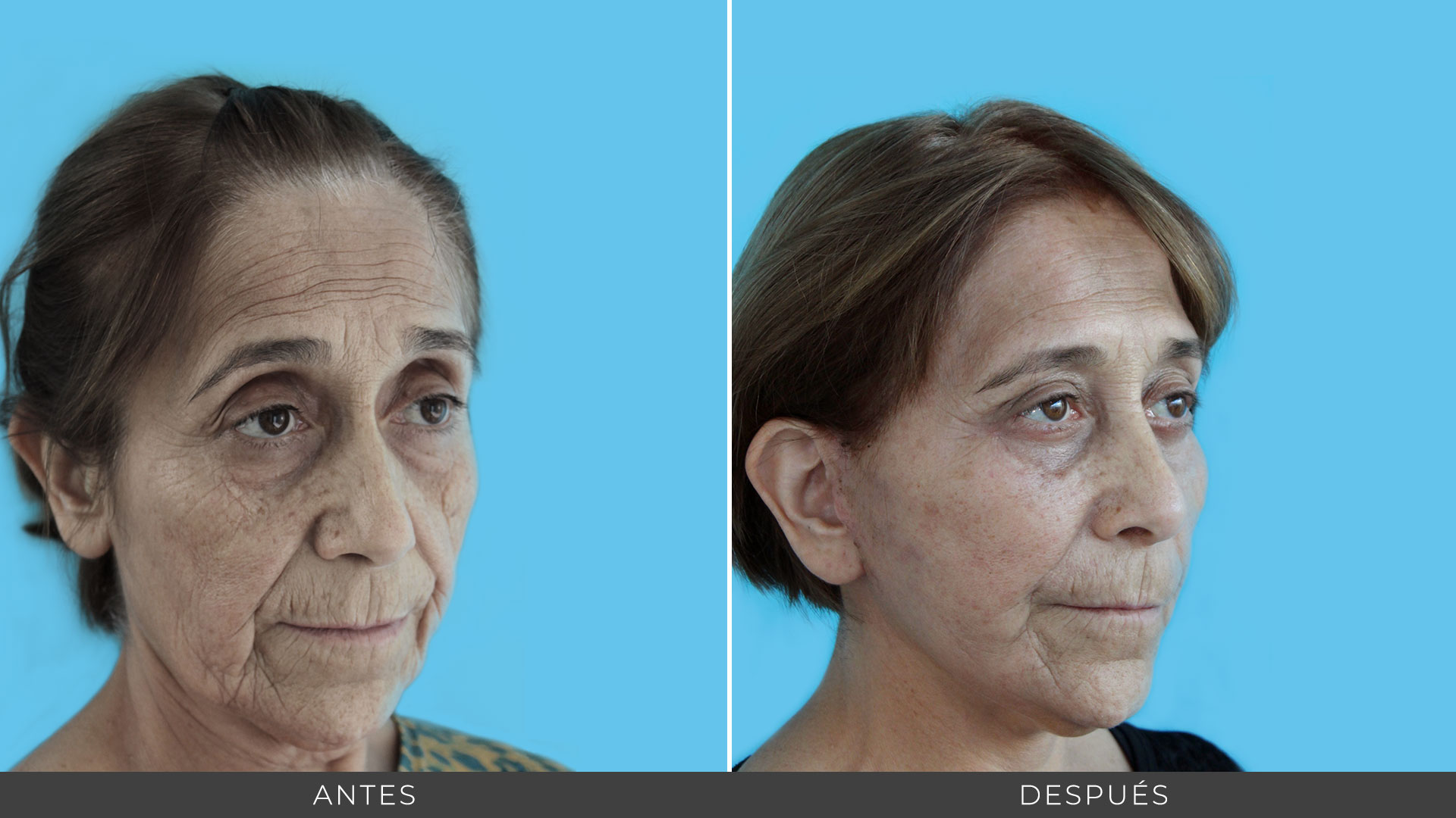 Lifting Facial - Clínica La Parva - Santiago, Chile