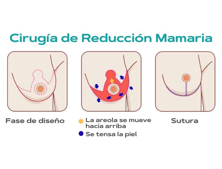 Reduccion_mamaria_en_Clínica_La_Parva_Recupere_el_bienestar_y_la_armonia_de_su_cuerpo