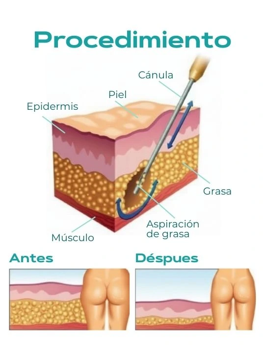 Gráficas de procedimientos quirurgicos