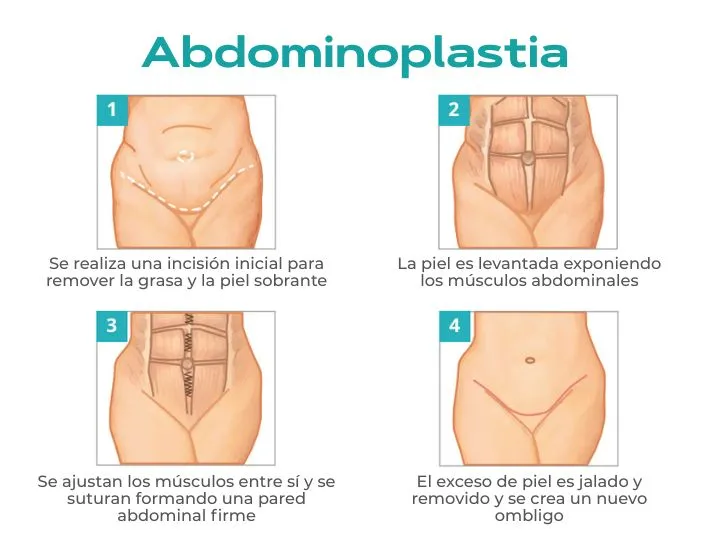 abdominoplastia
