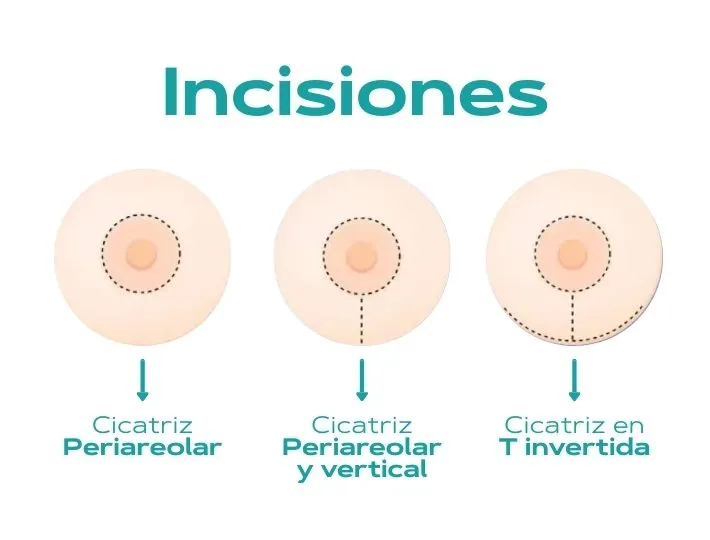 mastopexia_incisiones_grafica