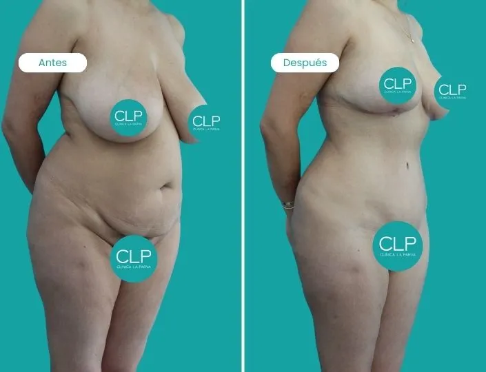 reduccion-mamaria-clinica-la-parva-02