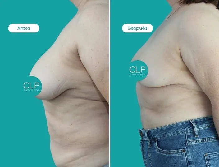 reduccion-mamaria-clinica-la-parva-03