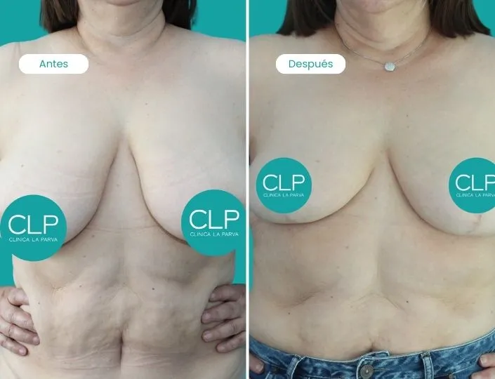 reduccion-mamaria-clinica-la-parva-06